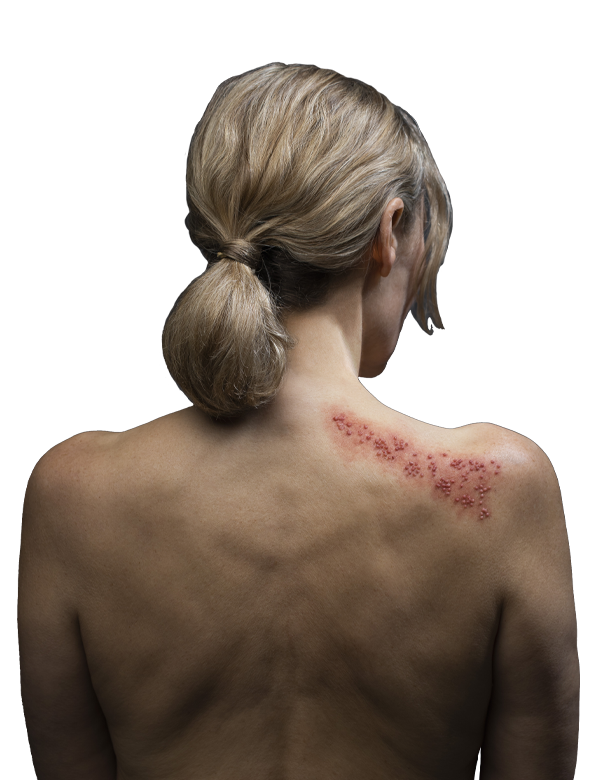 mulher herpes zoster de costas. mulher herpes zoster de costas.